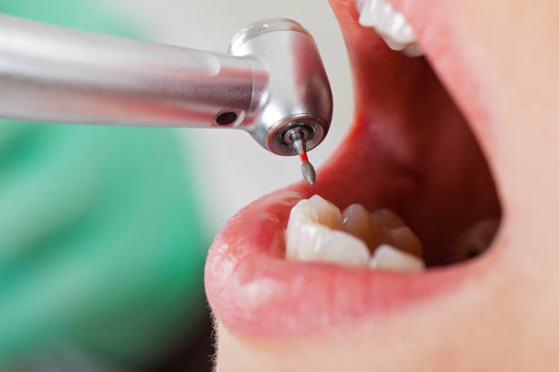 Best Emergency Dental Surgery in North Decatur, GA